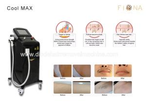 China Fast Safe Commercial Laser Hair Removal Machine Painless Permanent Treatment on sale