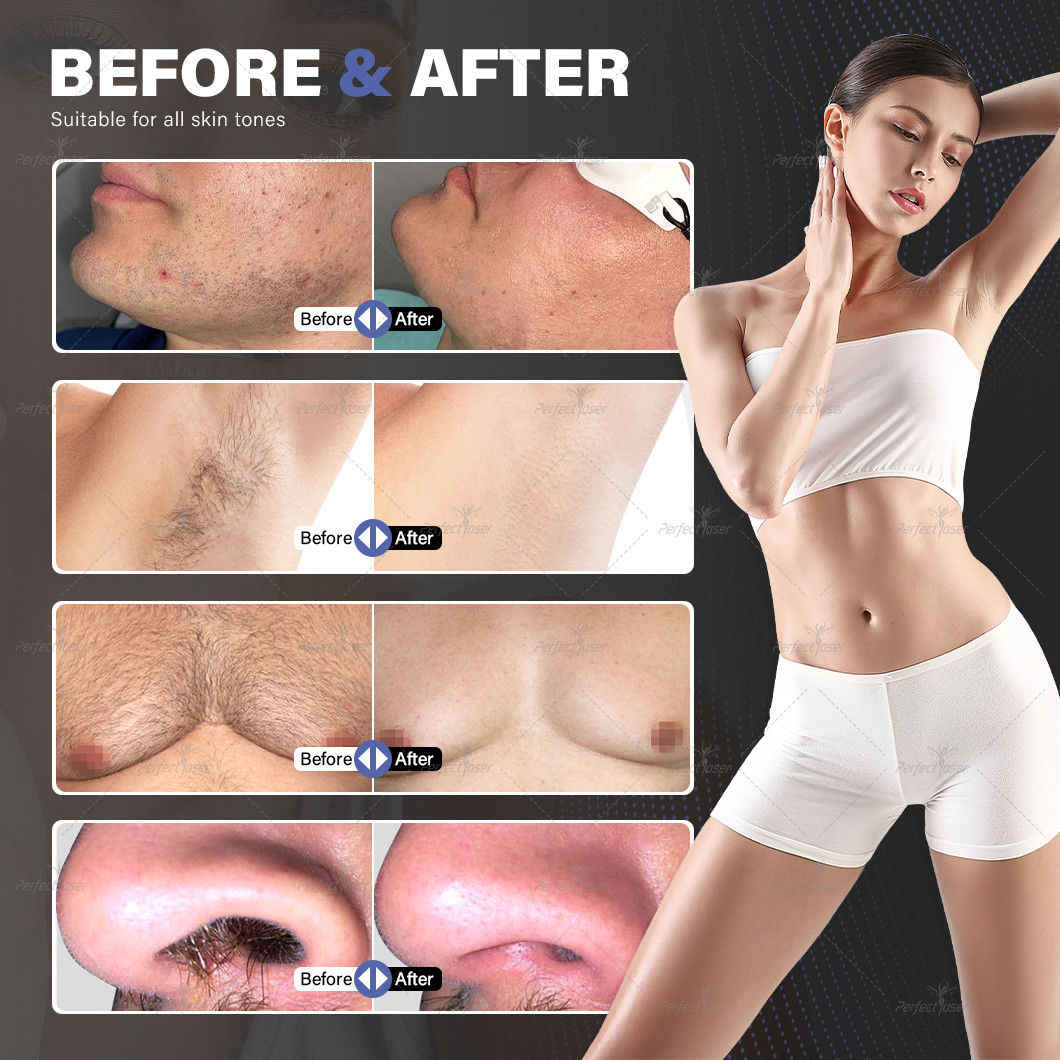 Energy Density Laser Hair Removal Machine Diode Laser with AC 220V Power Supply