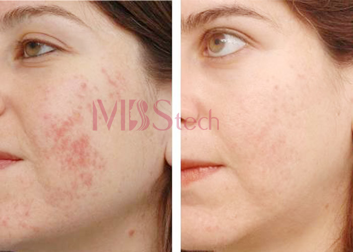 Skin Rejuvenation Face Lifting Thermagic Microneedle RF Machine