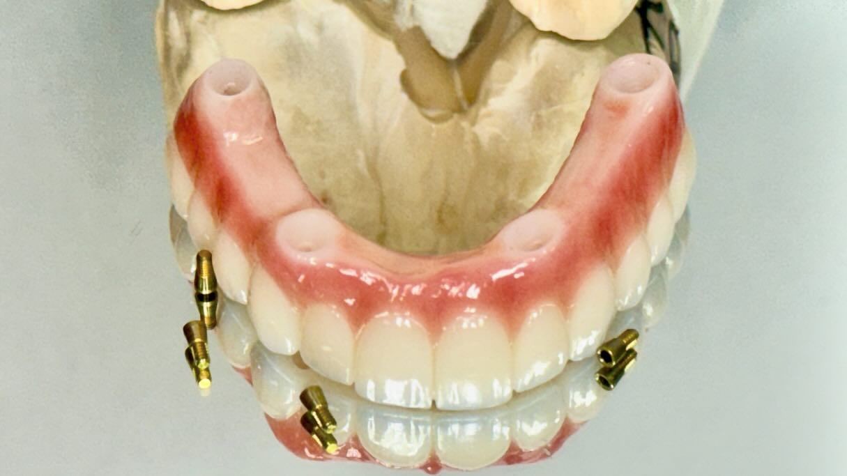 Dental All On X Implant PFM Crown Titanium Fixed Hybrid Denture