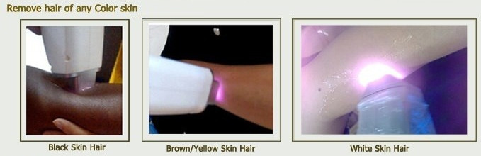 Permanent Depilation 808nm Diode Laser Machine , Korean Skin Permanent Epilation 808nm Diode Laser