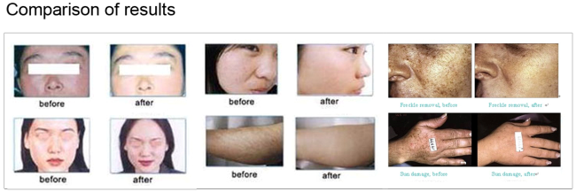 super ipl sincoheren monalisa diode laser epilation machine ipl