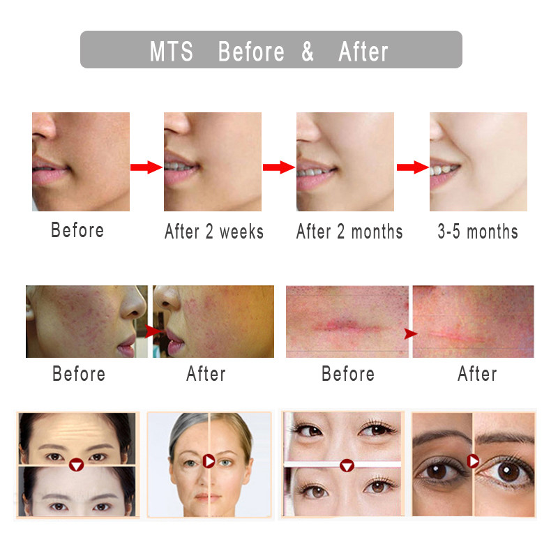 Dr.Pen M7-W Wireless Microneedling Cartridge Device Skin Tightening Micro Needle Stimulate Electric Stamp Dermapen