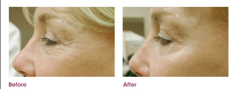 Fractional Co2 Laser Treatment Machine For Epidermis Resurfacing / Wrinkle Reduction
