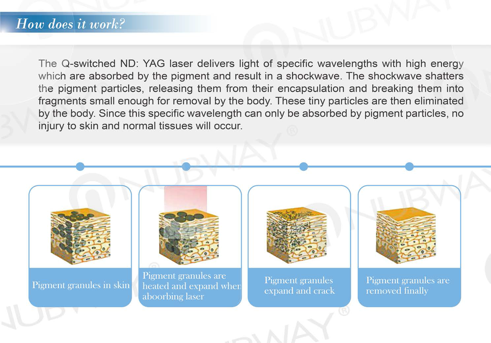Best effective nd yag laser tattoo removal machine / q switch nd yag laser pigments removal machine