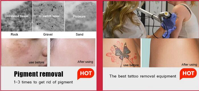 Picosecond q switched nd yag laser picosure q-switched tattoo removal laser machine