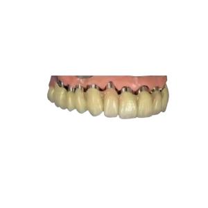 China CAD CAM PFM Implant Crown Bridge Telescopic Crown Dental 3D Printed Models wholesale