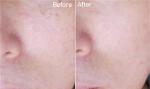 Best permanent hair removal laser ipl SHR machine