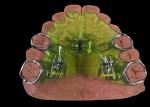 Mouthpieces Dental Tooth Orthodontic Appliances , Orthodontic Ligature Ties