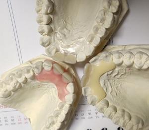 China Resin Metal Free Invisible Denture For Allergic Patient wholesale
