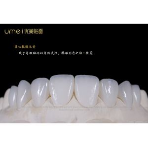 Ultra-thin aesthetic dental veneers