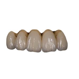 China Easy Maintain Orthodontic PFM Porcelain Dental Crown Colour Stability wholesale
