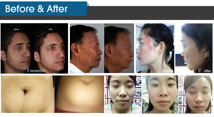 4 Handles Skin Rejuvenation Machine 60W Fractional CO2 Laser Device