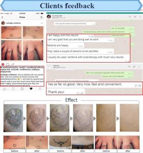 China Painless gentle yag laser 1064 nm 532nm pigments tattoo removal q switch nd yag laser wholesale