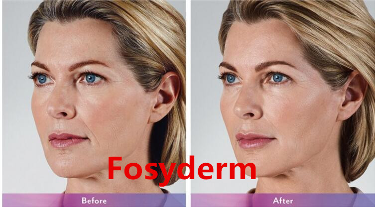 2ml Fine Hyaluronic Acid Dermal Filler , Injectable Fillers For The Face