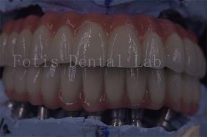 China Advanced Clinic Dental Implant Crowns For Superior Functionality wholesale