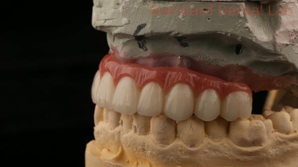 Hybrid Titanium Screw Retained Dental Implant Crown All On 4 Dental Implant
