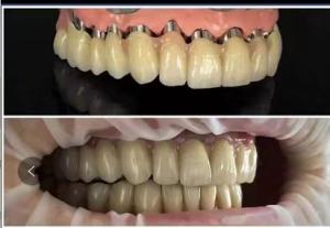 China Dental implants Telescope PFM porcelain bridge wholesale