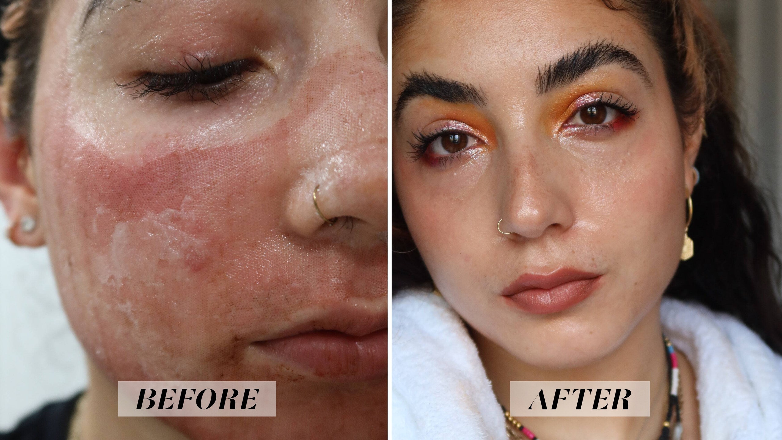 Tightening Skin Fractional CO2 Laser Beauty Machine For Acne Pigment Scar Removal