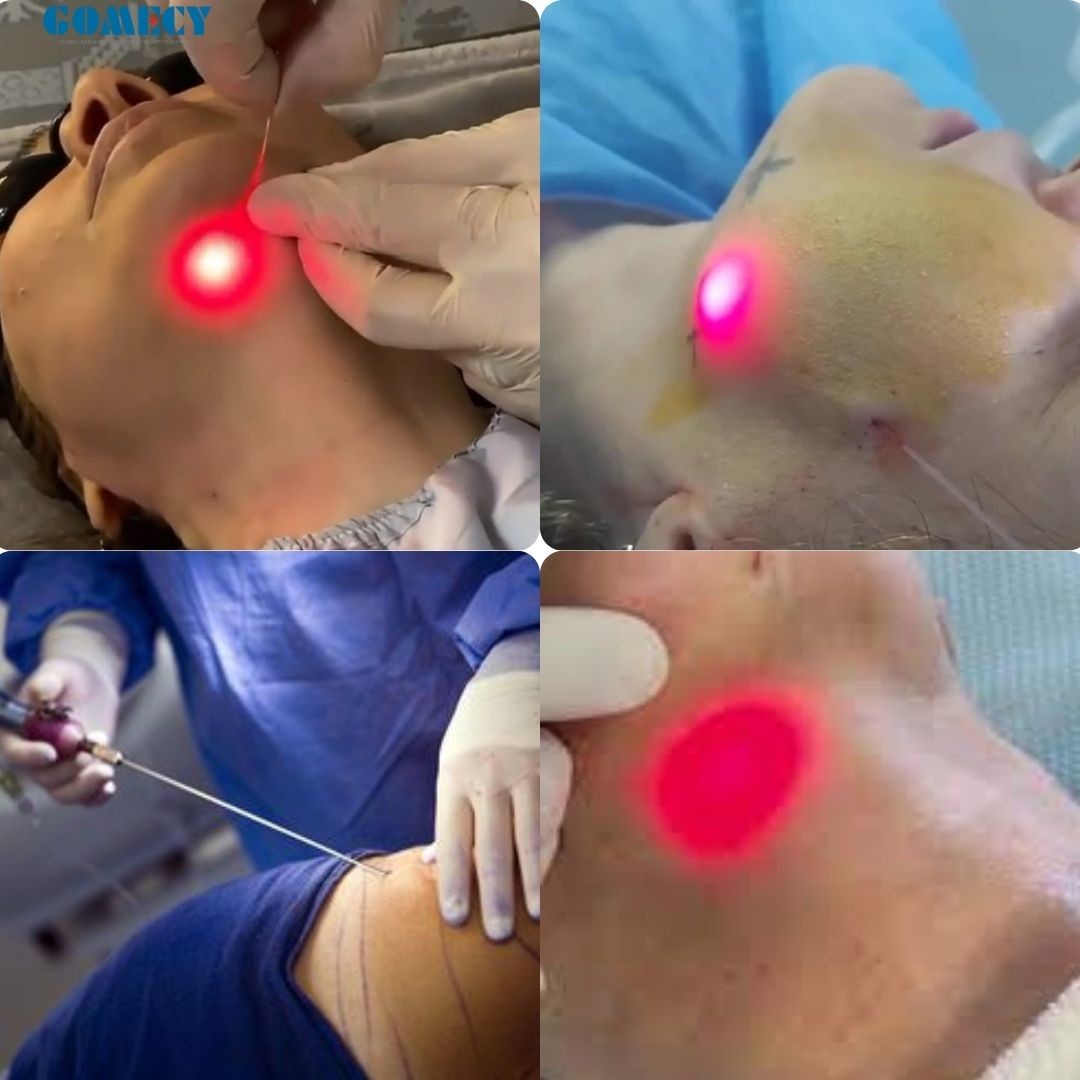 1470nm Face Lifting Lipolysis Laser Liposuction Machine Laser Fat Removal Endo Face Lifting 1470nm Machine