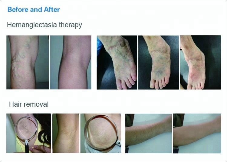 Long Pulsed ND YAG Laser Hair Removal Machine , 1064nm Laser Vein Removal Machine