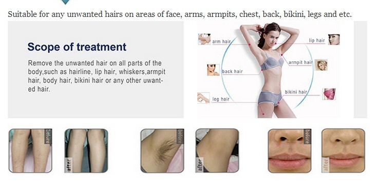 2000W Power 808nm diode laser hair removal machines laser 755nm hair removal machine