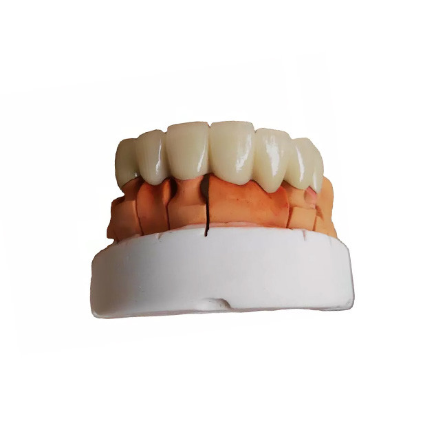Temporary PFM Dental Crown Smooth Surface High Quality Assurance