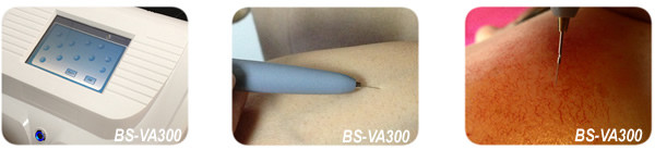 Vein Vascular removal spider veins vascular removal laser equipment