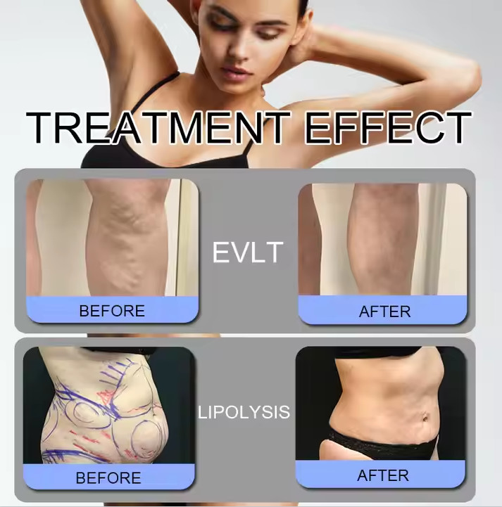 Powerful And State - Of - The - Art Laser Lipolysis Machine For Improved Skin Tone 40cm X 30cm X 40cm