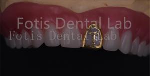China OEM Natural Full Acrylic Denture Ivoclar Teeth Stain Resistance wholesale