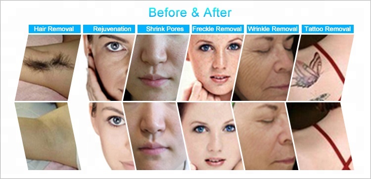 Hair Removal Skin Machine Rejuvenation Tattoo Face MJ402 Molde ROHS