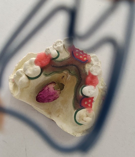 Casted Mandibular Arch Partial Denture Metal Framework
