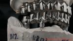 Dental Hybird Malo Implant Bridge Professional Perfect Fit FDA Certified