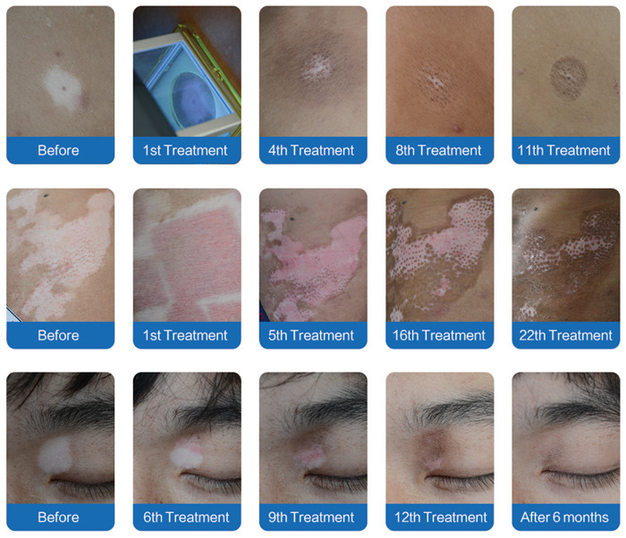CFDA Psoriasis Vitiligo Excimer Laser Side Effects XeCl