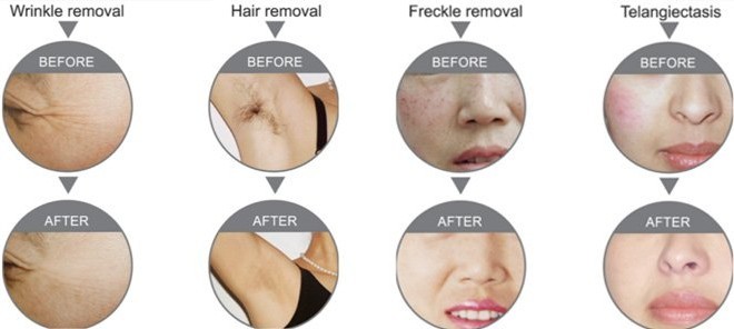 2000W Power 808nm diode laser hair removal machines laser 755nm hair removal machine