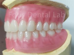 China OEM Full Upper And Lower Acrylic Denture Stain Resistance Natural Color wholesale