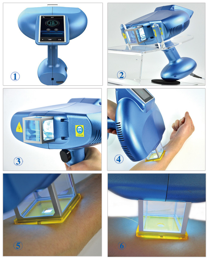 Psoriasis Xecl 308 Nm Excimer Laser FDA Vitiligo Light Machine