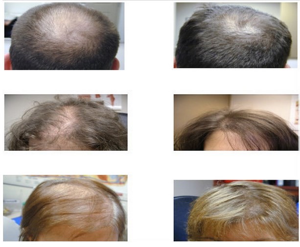 LED Laser Hair Growth Machine Vertical Photodynamic Regrowth Treatment Helmet