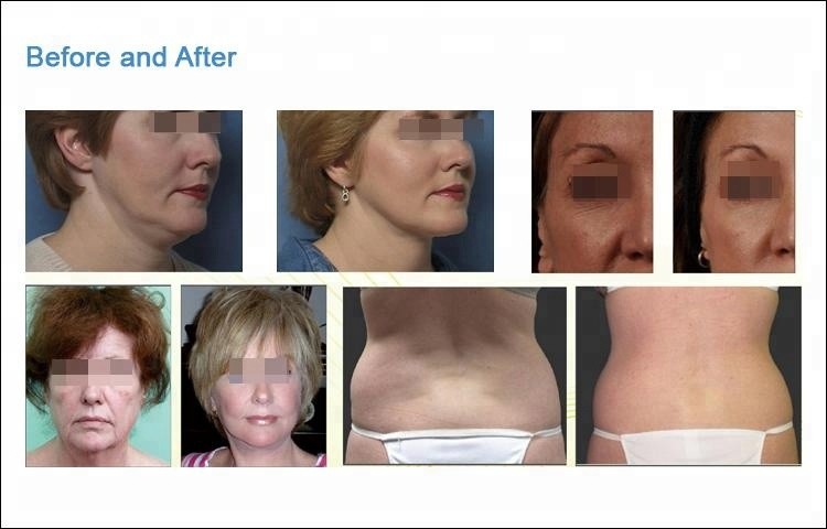 RF Skin Tightening Face Lifting Machine , Fractional RF Beauty Machine