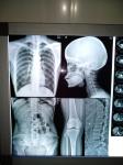 Low Fog 13x17 Inch Medical Dry Film Digital X Ray Film 330mmx432mm