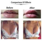 Cross Linked Hyaluronic Acid Filler Crosslinked Gel - Clinically Proven Sodium