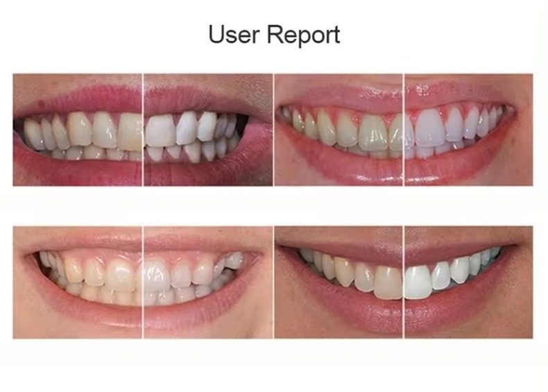 35% Teeth Whitening Gel Dr Whiten 30 Minutes Teeth Whitening Kit