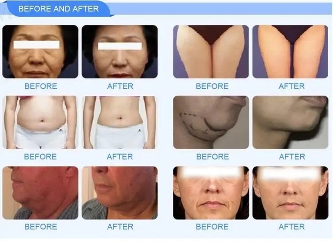12D CRYOHIFU Hifu Skin Tightening Machine Face Lifting Machine Focused Ultrasound Hifu