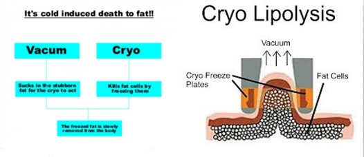 NUBWAY OEM 3 years warranty best result reduce 3-8cm Cryolipolysis Slimming Device