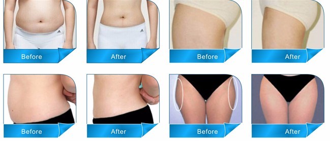2016 Newest Model Ultrashape / Liposonix / HIFU Slimming Machine with good quality