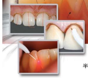 China Dental Tooth Whitening Machine dental laser teeth whitening wholesale