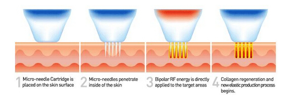 best results rf treatments for face with 0.5-3mm invasive microneedle