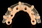 Titanium Static Guided Surgery Solutions For Implant Therapy Highly Accurate
