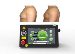 China 16W Laser Lipolysis Machine Gynaecomastia Treatment Minimally Invasive wholesale