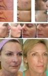 Rf Microneedle Fractional Radio Frequency Machine Face Lift Wrinkle Removal